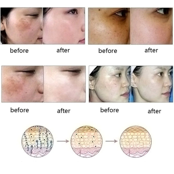 Natural Acne Removal Scar Oil